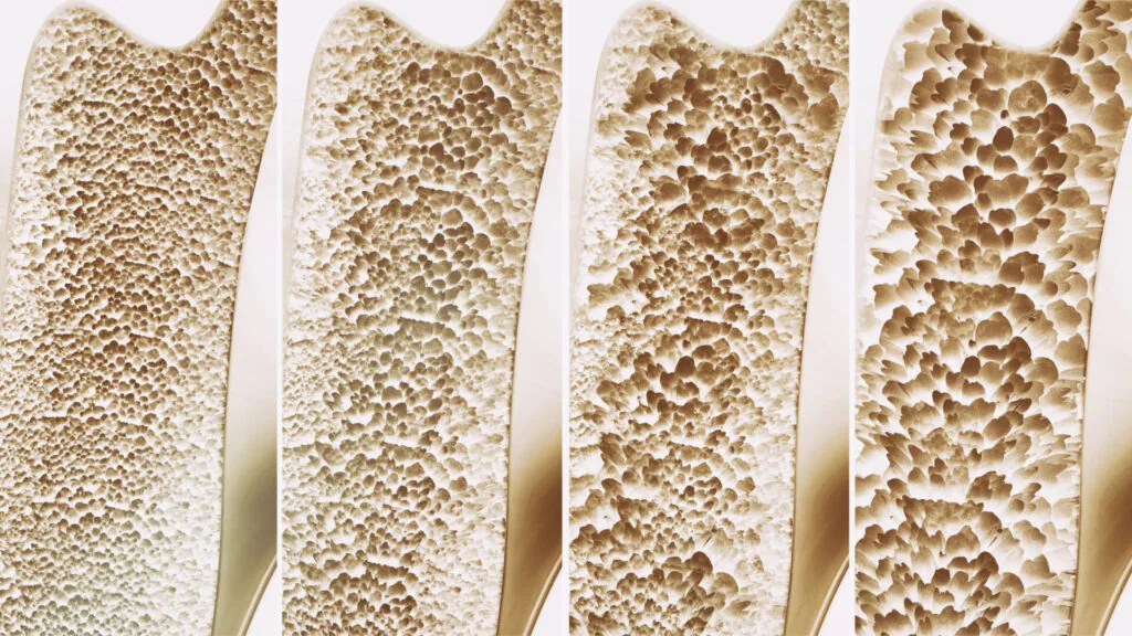 Four cross-sections of bone showing progressive porosity, demonstrating bone density changes from dense to severely porous