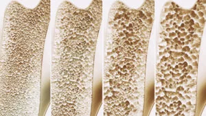 Four cross-sections of bone showing progressive porosity, demonstrating bone density changes from dense to severely porous