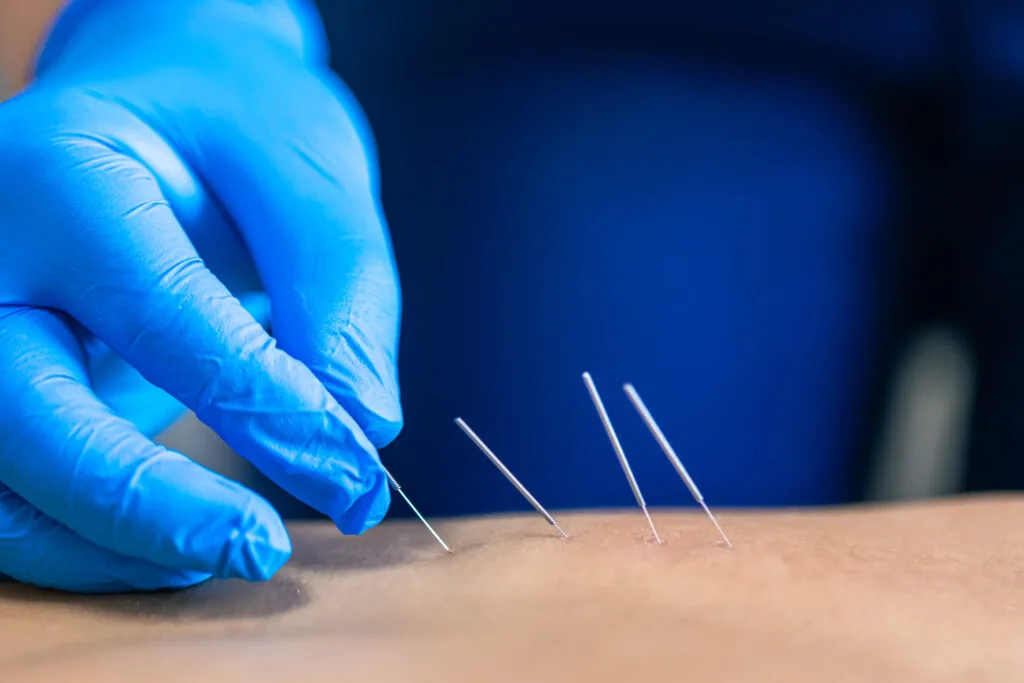Dry needling